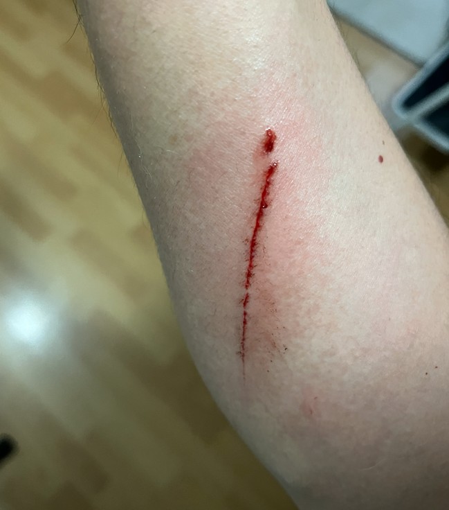 Brazo con herida reciente