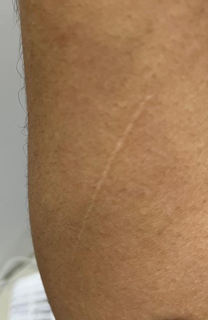 Evolución de la cicatriz del brazo