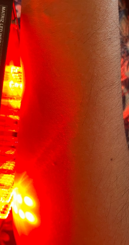 Brazo en terapia con matriz LED